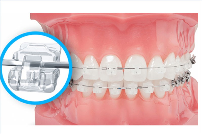 Niềng răng mắc cài 12 mac cai 4