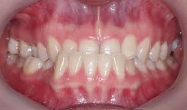 Niềng răng cho trẻ em 8 2 3