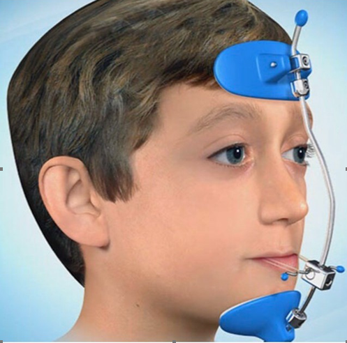 Niềng răng cho trẻ em 9 3 2