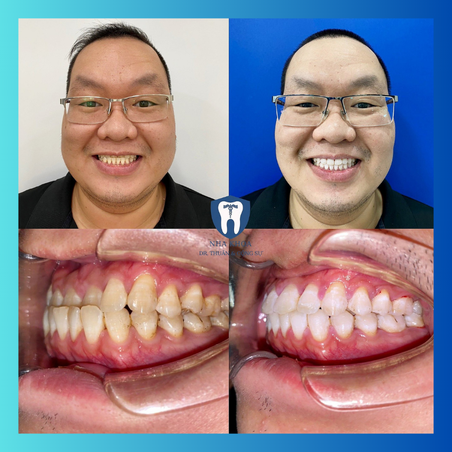 Trải nghiệm dịch vụ niềng năng tại nha khoa dr thuần 1