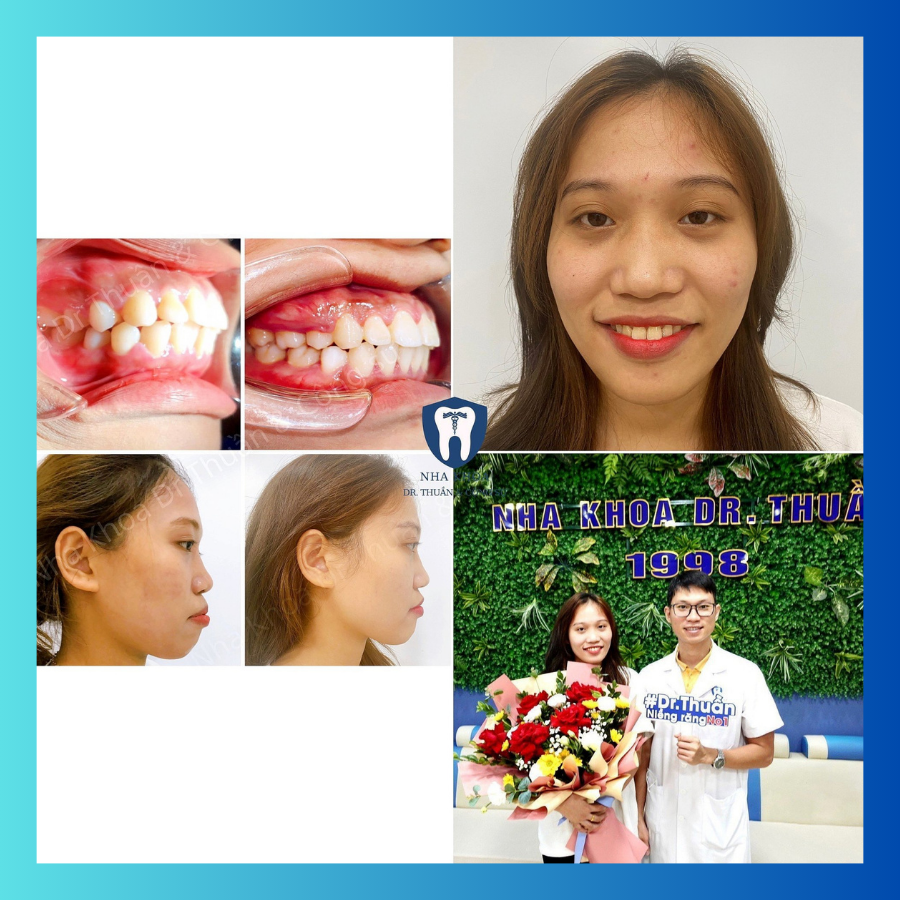 Trải nghiệm dịch vụ niềng năng tại nha khoa dr thuần 2