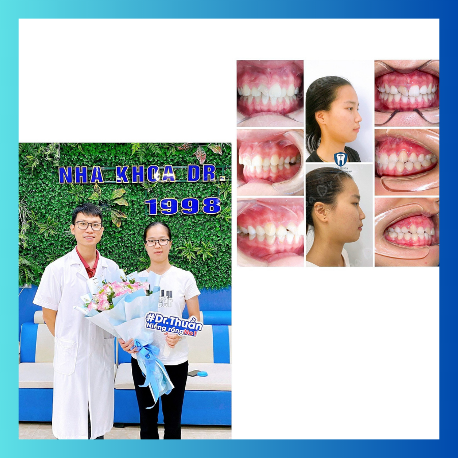 Trải nghiệm dịch vụ niềng năng tại nha khoa dr thuần 4